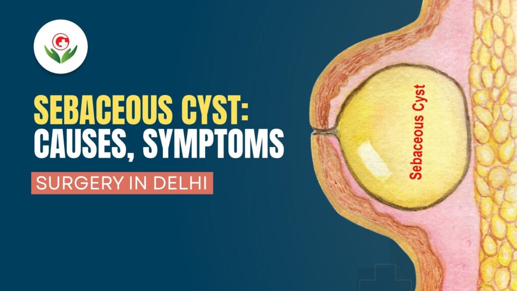 Sebaceous Cyst Causes, Symptoms
